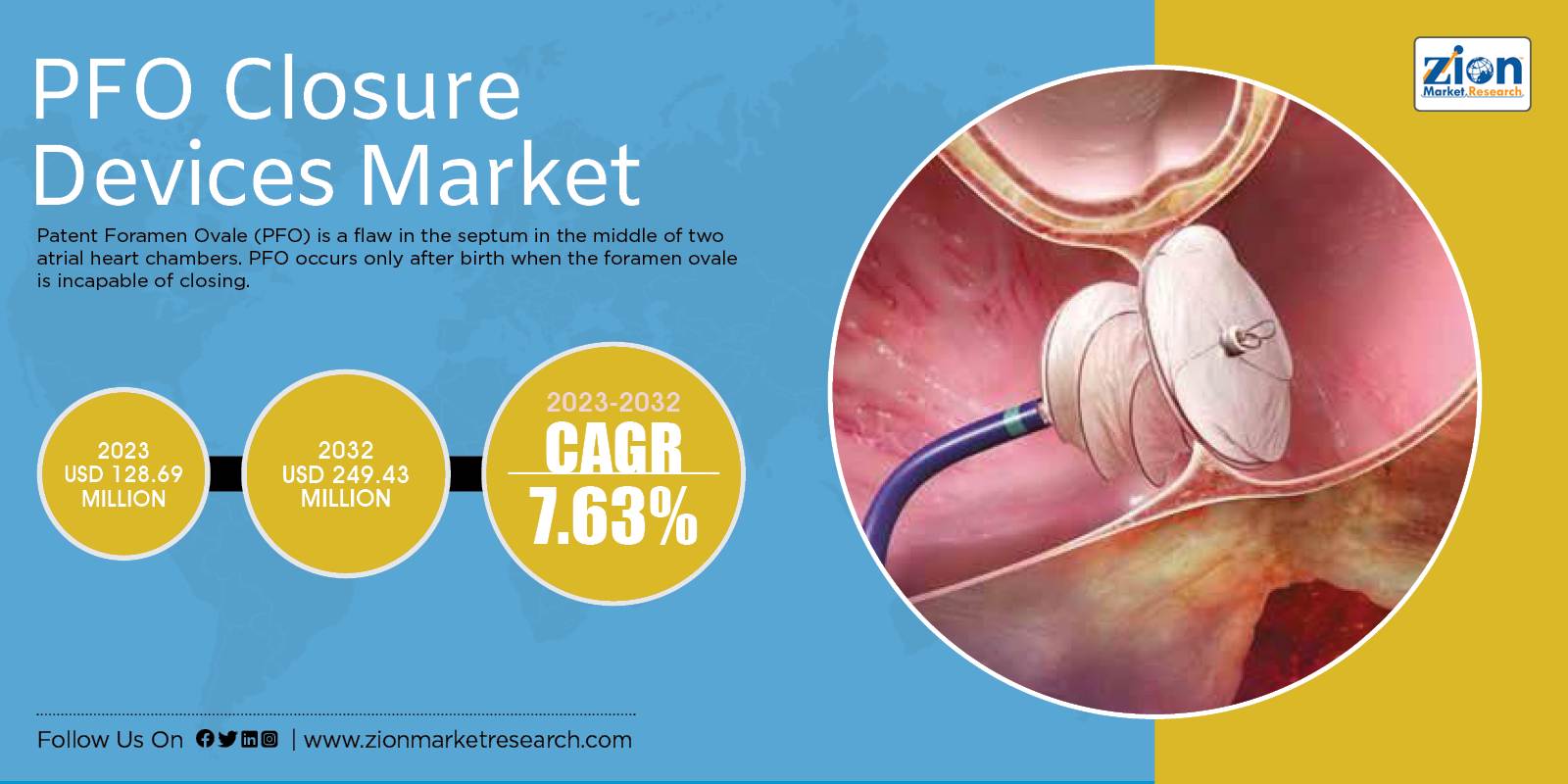 Global PFO Closure Devices Market