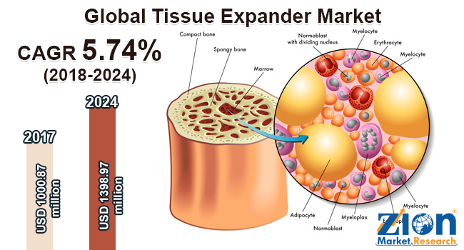 Global Tissue Expander Market